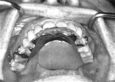 THE JOURNAL OF PROSTHETIC DENTISTRY ARAMANY Fig. 3. In Class II design, the teeth next to the defect are splinted.