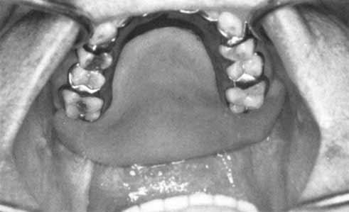 ARAMANY THE JOURNAL OF PROSTHETIC DENTISTRY Fig. 5. In Class III retention, bracing and support are derived from four widely separated abutment teeth. Fig. 6.