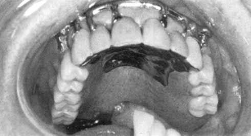 Fig. 10. A porcelain-fused-to-gold splint is used on the six anterior teeth and a hinge-gate obturator prosthesis is used to restore a Class V defect. Fig. 11.