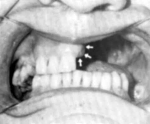 THE JOURNAL OF PROSTHETIC DENTISTRY ARAMANY SUMMARY A classification for partially edentulous maxillectomy patients has been proposed, and a suggested design for each class is discussed.