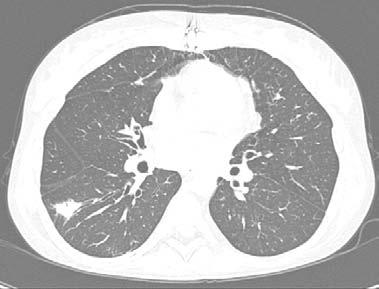 Lung transplantation Figure 3 Pulmonary nodules on CT. dysfunction [2]. In two of the present cases, extrapulmonary involvement was associated with lung dysfunction.