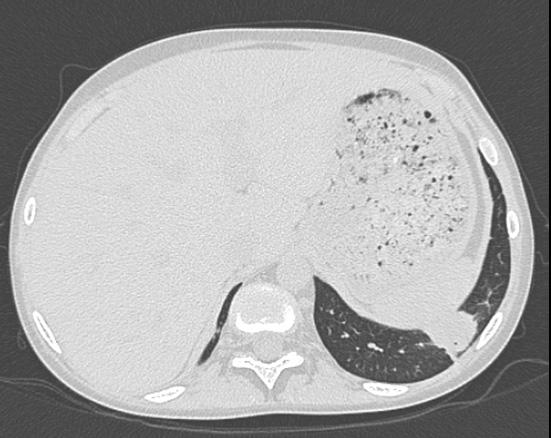 This term reflects graft deterioration due to a persistent airflow obstruction [10]. However, not all lung transplant recipients in whom airflow obstruction develops have BOS.
