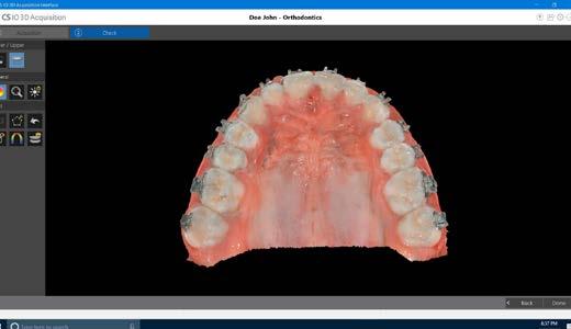 highlight on, or monochromatic Obtain dual arch full palatal scans quickly and easily for the creation of digital study models, orthodontic appliances and retainers.