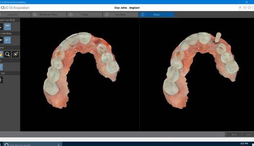 Dual scan mode allows you to scan the same implant region of interest twice once with the scanbody in place and once without to capture more precise data.