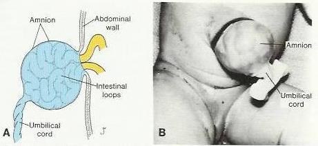Congenital Omphalocele It is a persistence of herniation of abdominal contents into proximal part of umbilical cord due