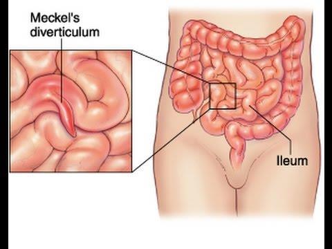 It is sometimes becomes inflammed and causes symptoms that mimic appendicitis.