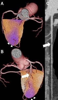 Coll Cardiol. 2009 Feb 17;53(7):623-32. Prognostic value of hybrid imaging Impact of hybrid imaging on downstream resource utilization 1.0 Normal 100% p<0.