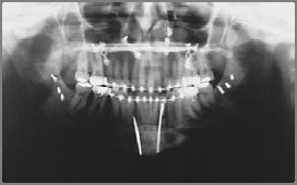 Classifications Tooth Fracture