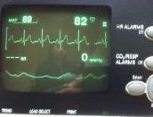 resp rate & i tidal volume stimulate patient to take a deep breath now get alveolar CO2 a h CO2 level