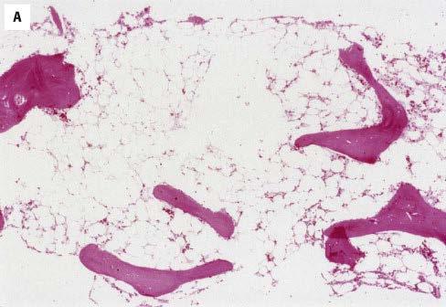 2012 Pathology - Bone Marrow Biopsy In severe cases, the cellularity is typically <25% of expected
