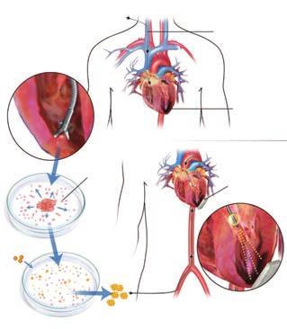 REGENERATIVE CELL THERAPY, a one-time treatment, infuses adult stem cells into the damaged weakened areas of the heart, allowing new cells to repair, restore, and even replace the damaged heart