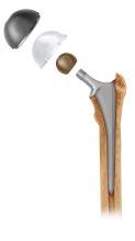 FEMORAL HEAD SELECTION Perform the trial reduction using a +5.0 mm Articul/eze trial head, to allow for one size up or down without having to use a skirted femoral head.