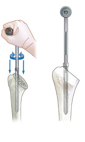 5. Reaming the humeral shaft Accurate visualization of the plane through which the humerus is cut (fig. 14) allows the hinge point to be located.