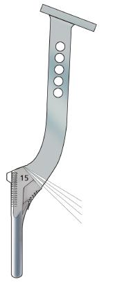 Retroversion is observed by aligning the fin of the compactor with the slot created by the osteotome