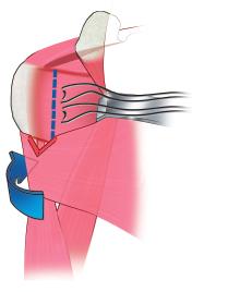 A modified Mason-Allen interlocking suture is placed at the top corner of the subscapularis adjacent to the rotator interval (fig. 08).
