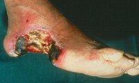 8 of 8 3-12-2012 12:19 Deep foot ulcer (depth:grade 4) with