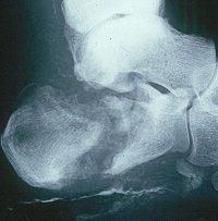 of steroids treating a plantar tendonitis.