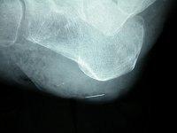 body - a needle - identified through X-ray.