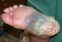 associated with ischemia of the forefoot with high probability for
