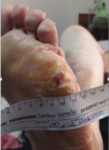 During this time, regular debridement was carried out; however, the wound failed to progress as expected. Due to the lack of progression, NATROX was initiated.