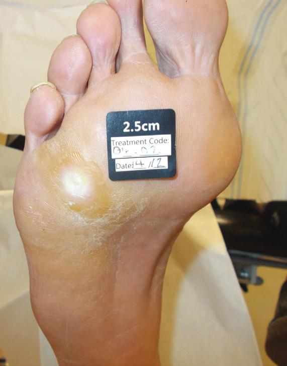 The patient had been attending the clinic twice weekly for the past 10 weeks with a small but challenging diabetic foot ulcer to his fourth metatarsal head.