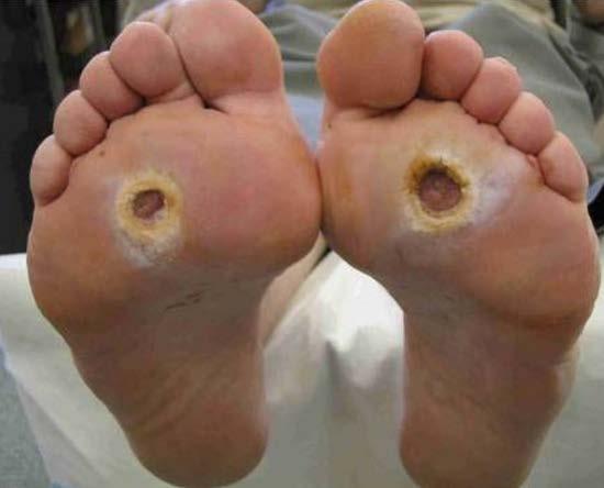 Diabetic Foot Ulcer Statistics 15 to 25% of diabetics will develop a DFU Only two-thirds heal within 6 months