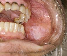 Oral Pre-Malignant Lesions Leukoplakia: white plaque