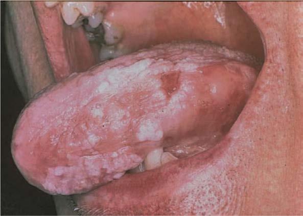 The chance of transformation into oral squamous cell carcinoma