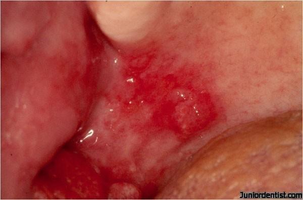 Oral Pre-Malignant Lesions Erythroplakia red plaque Far less common than
