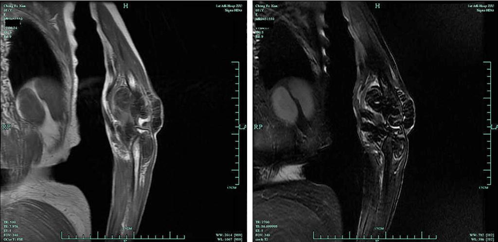 Figure 2. MRI of pre-operation showing T1-weighted images. Multiple masses located in internal and external joint showed mildly low signal intensity to muscle; T2-weighted images.