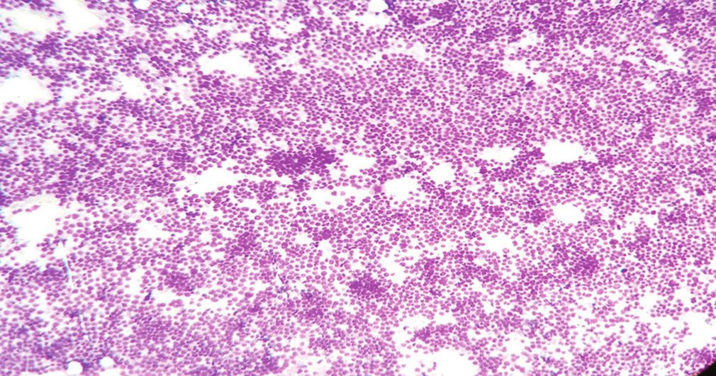 6% cases of lymphomas in their series.5 Figure 7: Poorly differentiated (MGG stain, 0) series, granulomatous lymphadenitis was the second most common diagnosis offered. In the series of Kumar et al.