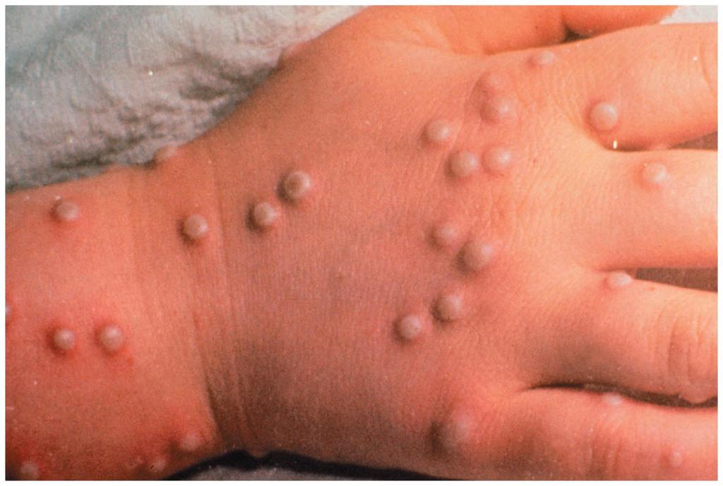 Viral Diseases of the Skin Warts Caused by papillomavirus Smallpox Caused by an orthropoxvirus Transmitted via the respiratory route,