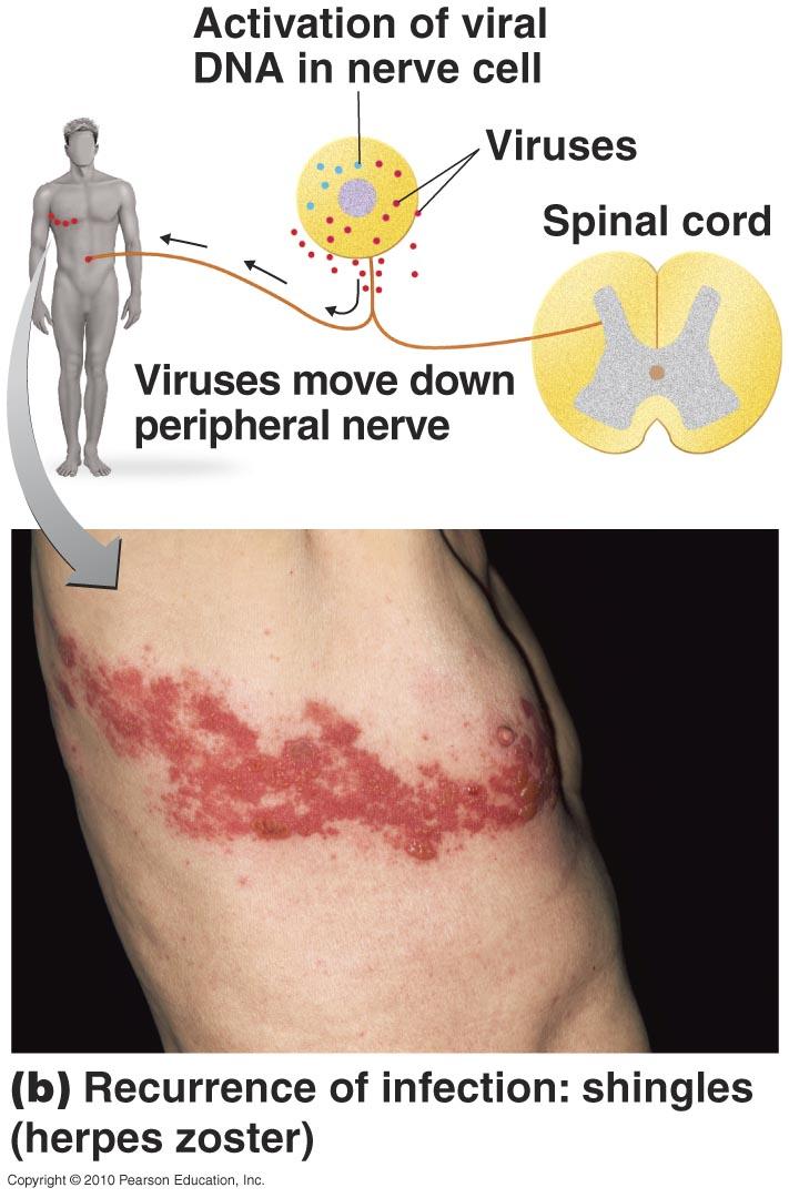 Shingles (herpes zoster) Reactivation of the latent varicella-zoster virus that moves along peripheral