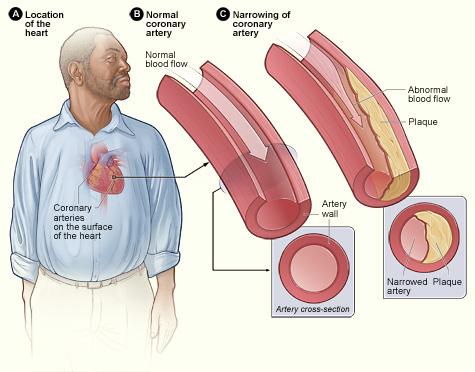 The doctor performs this procedure to look for narrowing or blockage in the blood vessels that supply the heart (see Figure 1). Figure 1. A shows the location of the heart in the body.
