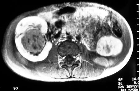 Figure 6. Magnetic resonance imaging scan of patient 2. A large, centrally located right renal mass and a small (2-cm) left renal mass are demonstrated.