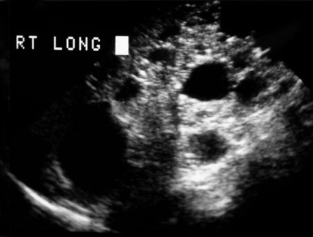 A A B Figure 9. Renal ultrasonograms of a patient with tuberous sclerosis complex.