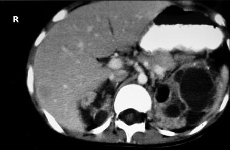 On occasion, a child with renal cell carcinoma also may have hypertension, polycythemia, or other paraneoplastic syndromes.