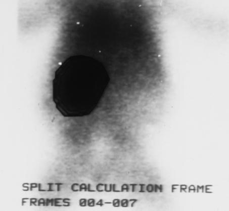 Figure 12. Nuclear renal scan in patient with multicystic dysplastic kidney. A complete lack of function on the ipsilateral side is demonstrated.