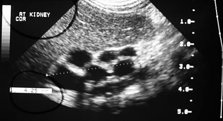 A A B Figure 1. (A) Renal ultrasonogram demonstrating right-sided hydronephrosis secondary to a ureteropelvic junction obstruction.