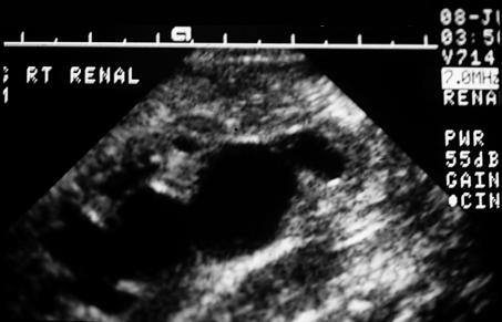 (B) Renal ultrasonogram demonstrating multiple right hypoechoic regions throughout the right kidney, consistent with multicystic dysplastic kidney.