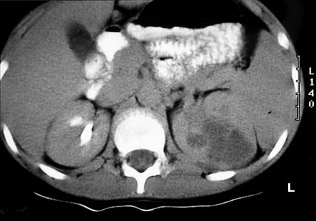 For this reason, even those tumors thought to be benign (eg, angiomyolipoma or multicystic dysplastic kidney) require evaluation with serial imaging. B Figure 2.