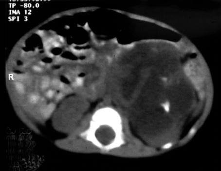 (B) CT scan of a 10-year-old boy demonstrating an inhomogeneous left renal mass. Pathologic examination revealed an anaplastic mesenchymal tumor.