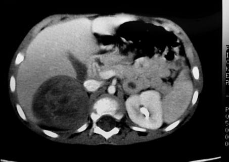 the renal pelvis, suggesting possible obstruction. Two small (< 0.5 cm) probable lymph nodes are present in the periaortic region. The left kidney and inferior vena cava appear normal.