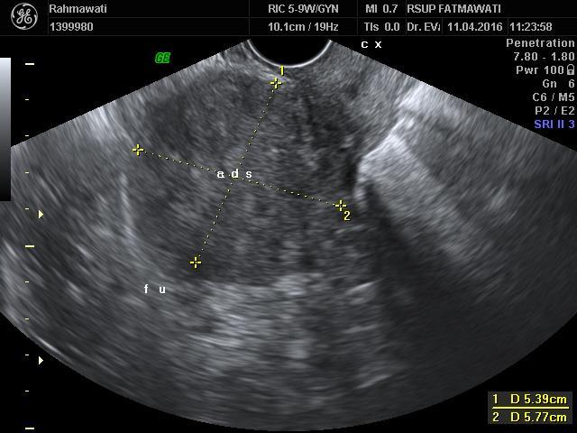 diffuse adenomyoisis at anterior part of the uterus, Left