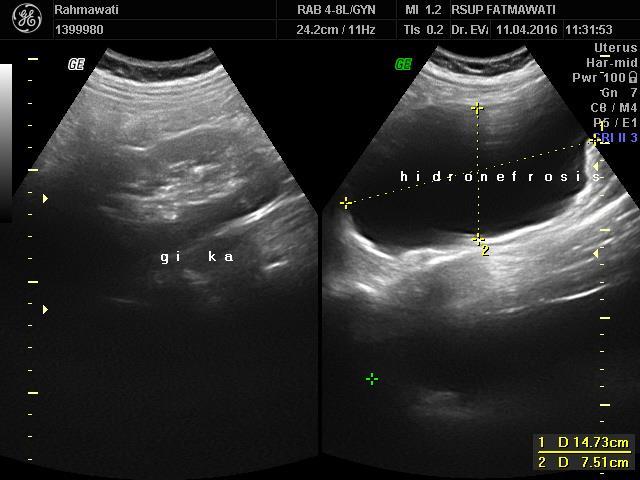 distal part due to Endometriosis lession. (Figure 3) Figure 3.
