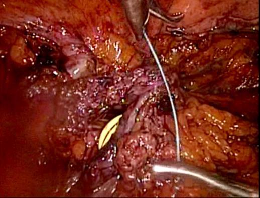 On exploration found enlargement of the left ureter, found no endometriosis lession but there was ureter stricture.