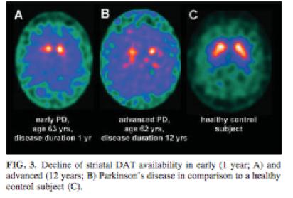 Dopamine transporter imaging (DaT scan) How is Parkinson s disease diagnosed?
