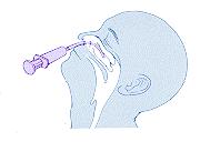 8. Carefully remove the feeding tube from the nose. 9. Detach the feeding tube from the syringe. 10. Inject the contents of the syringe into the specimen container. 11.