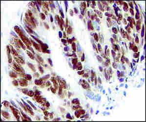 The brown stain (immunohistochemistry, PAP) shows that the mutated p53