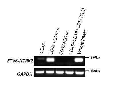 Generation of an ETV6-NTRK2 AML patient-derived